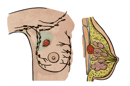 Esquema del cáncer de mama y sus metástasis