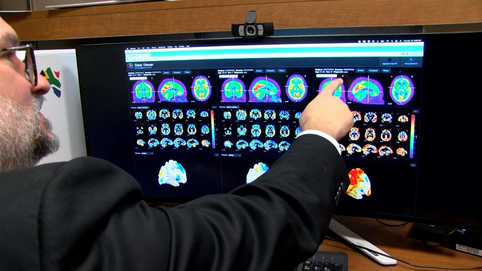 Médico señalando imágenes de escáner cerebral en una pantalla