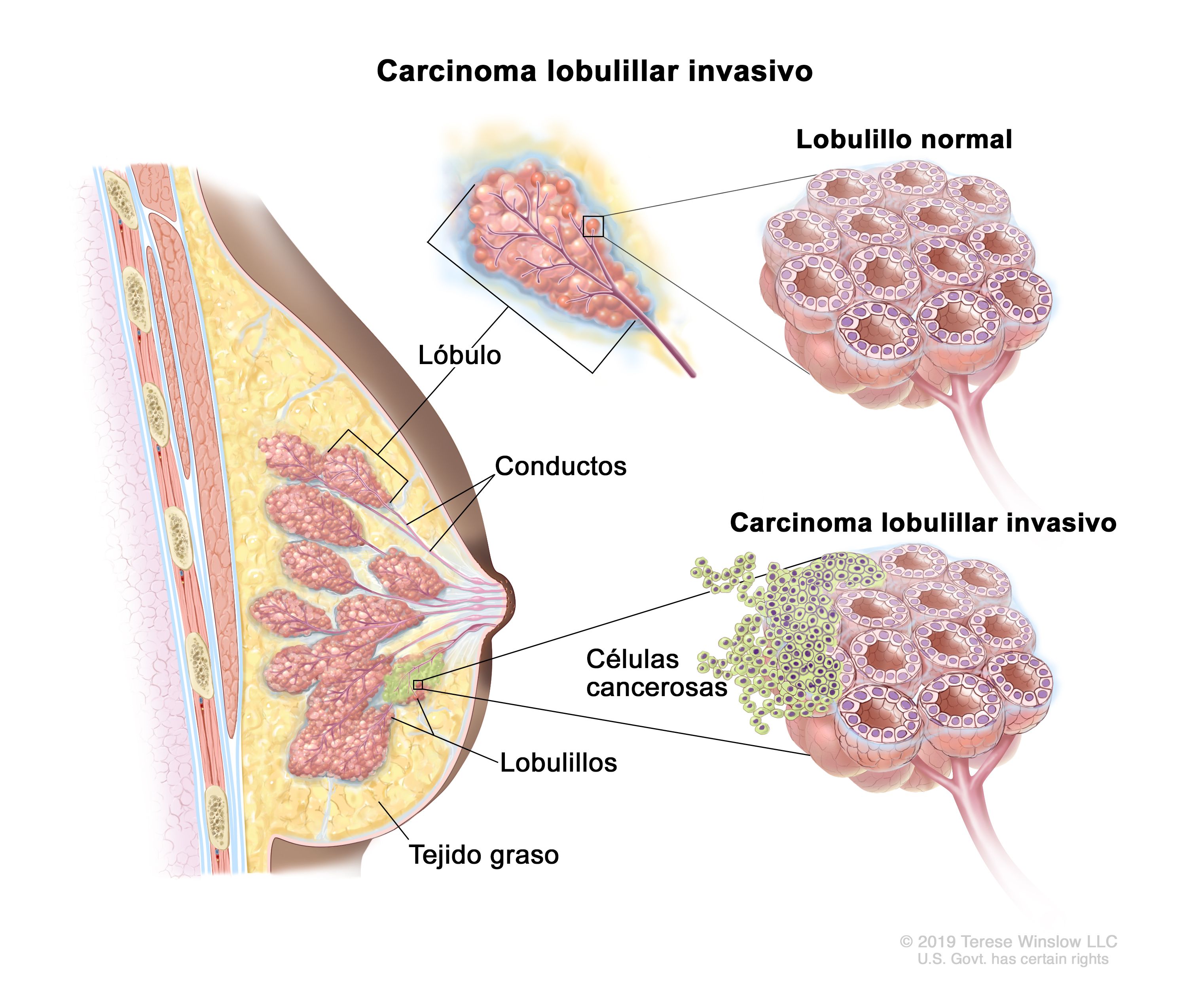 Células de cáncer de mama bajo microscopio