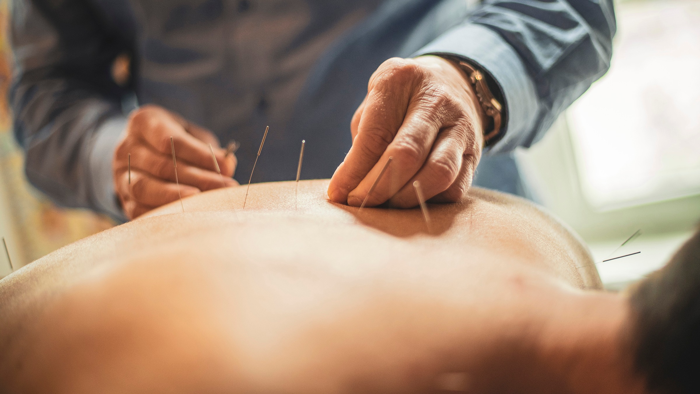 Acupuntura