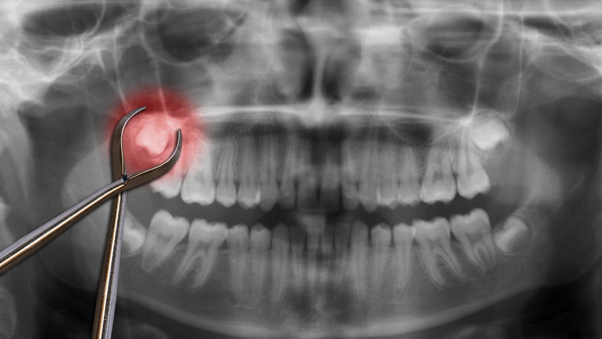 Tooth Extraction Treatment