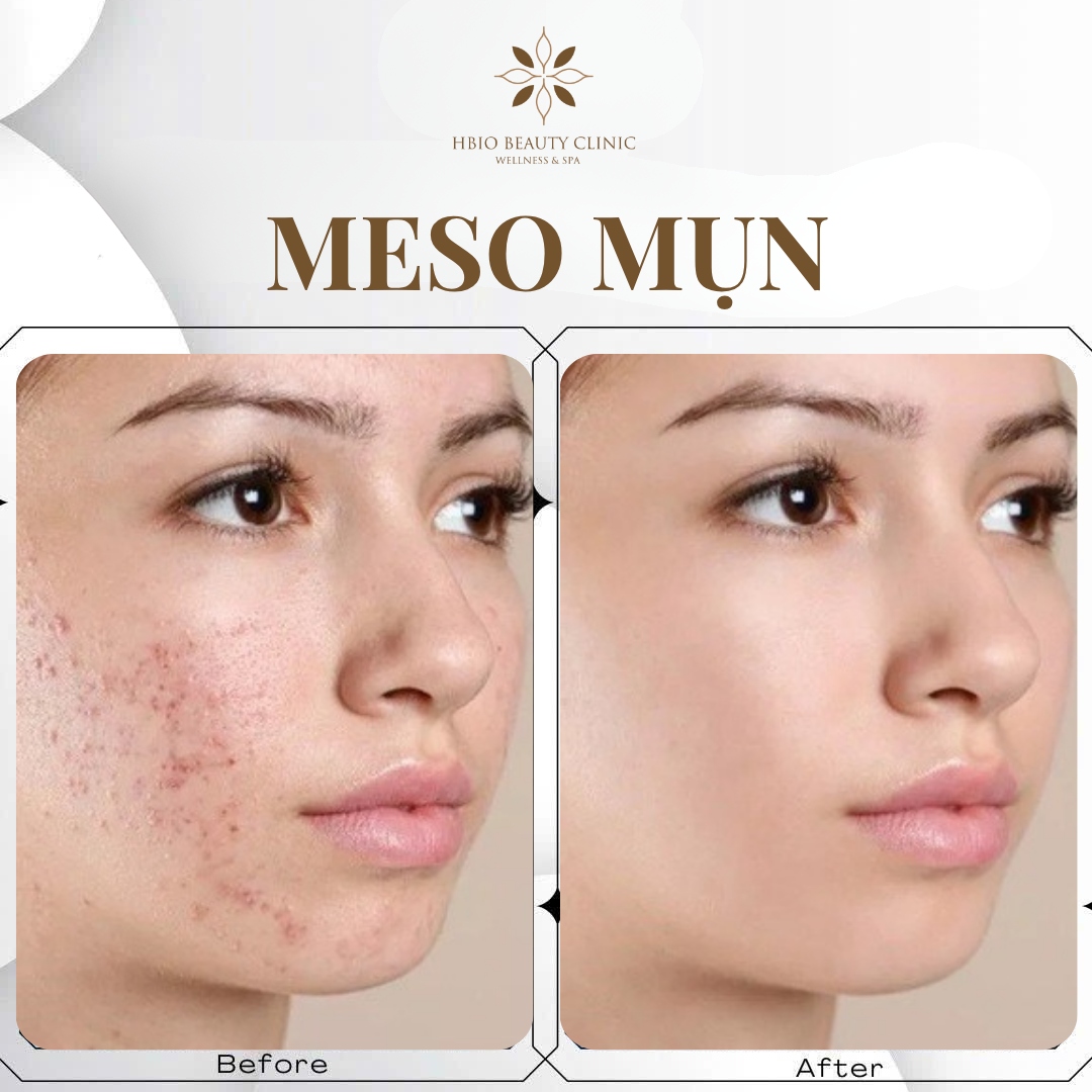 Mesoterapia Virtual Facial