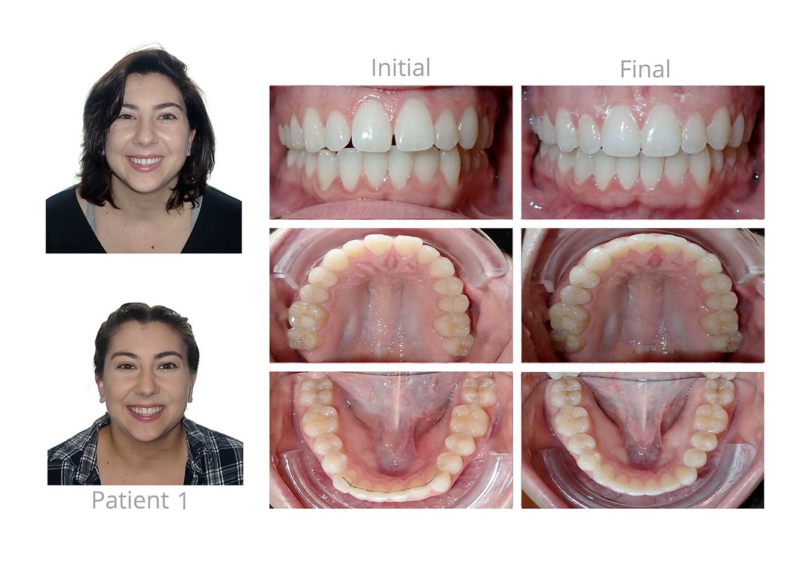 Dental Braces Treatment