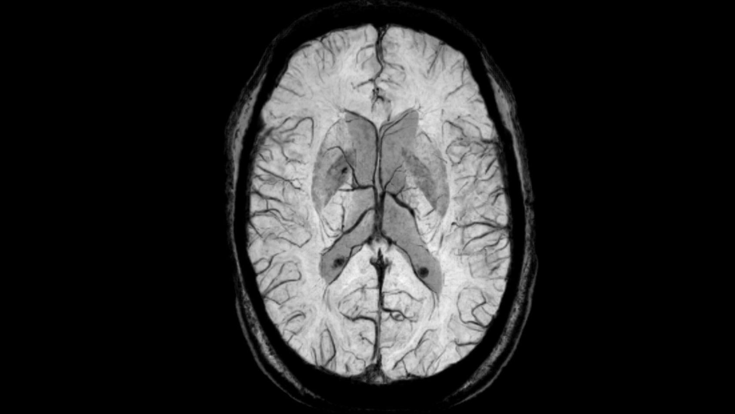 Brain MRI scan visualization