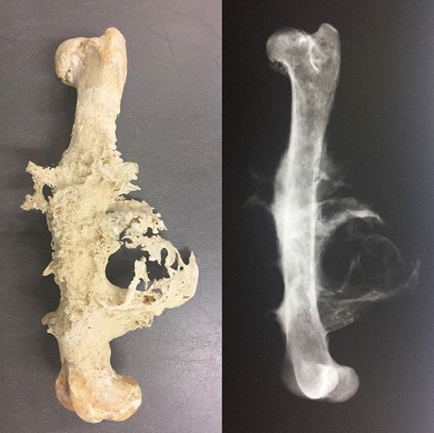 Comparación de un hueso normal y uno afectado por osteosarcoma