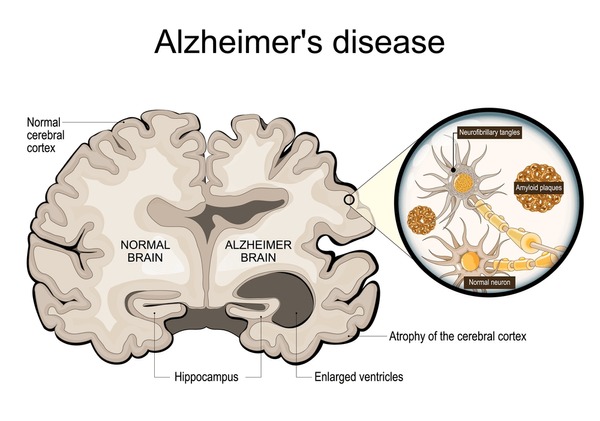 Comparación entre cerebro sano y cerebro con Alzheimer