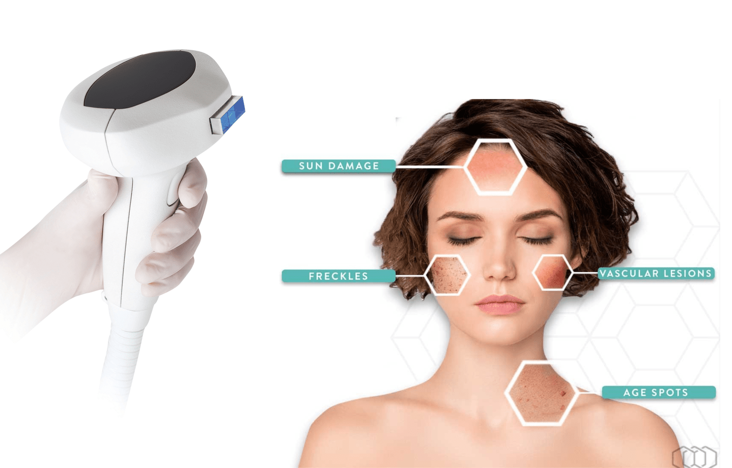 Fotorejuvenecimiento con Luz Pulsada (IPL)