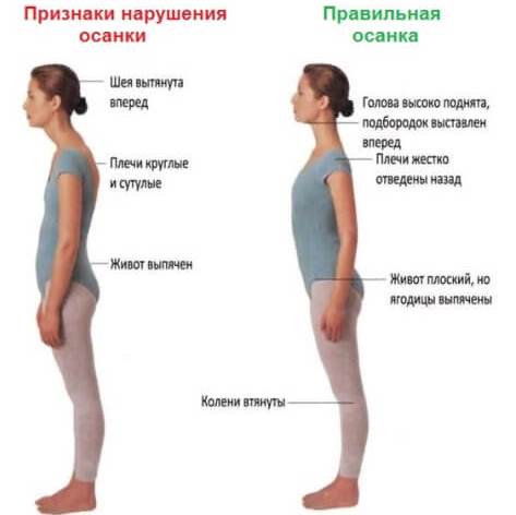 Сравнение правильной и неправильной осанки человека.
