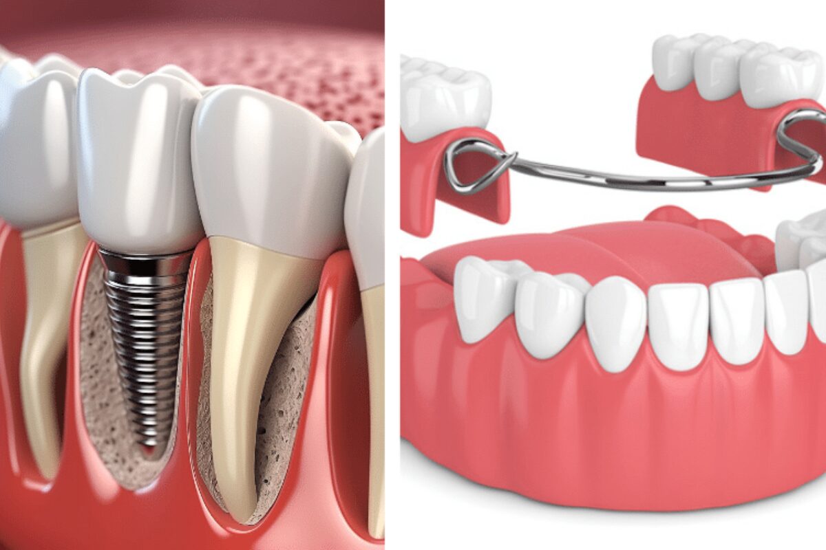 Artificial Teeth Dentures